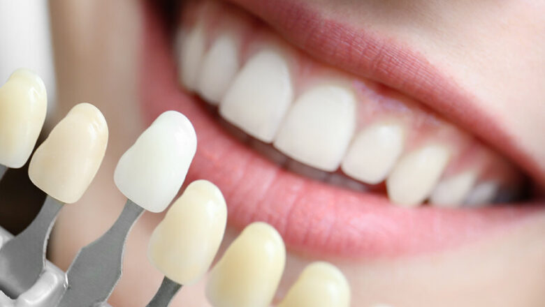 Эстетическая реставрация зубов композитом Enamel HRi, или Один прием у врача для белоснежной улыбки